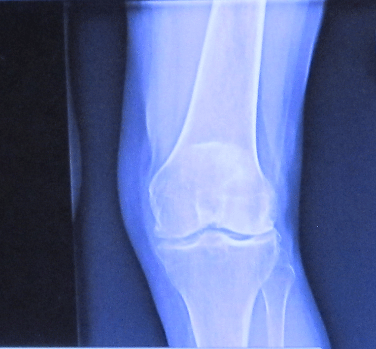 bone on bone patella