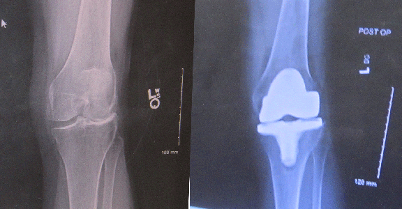 bone on bone patella